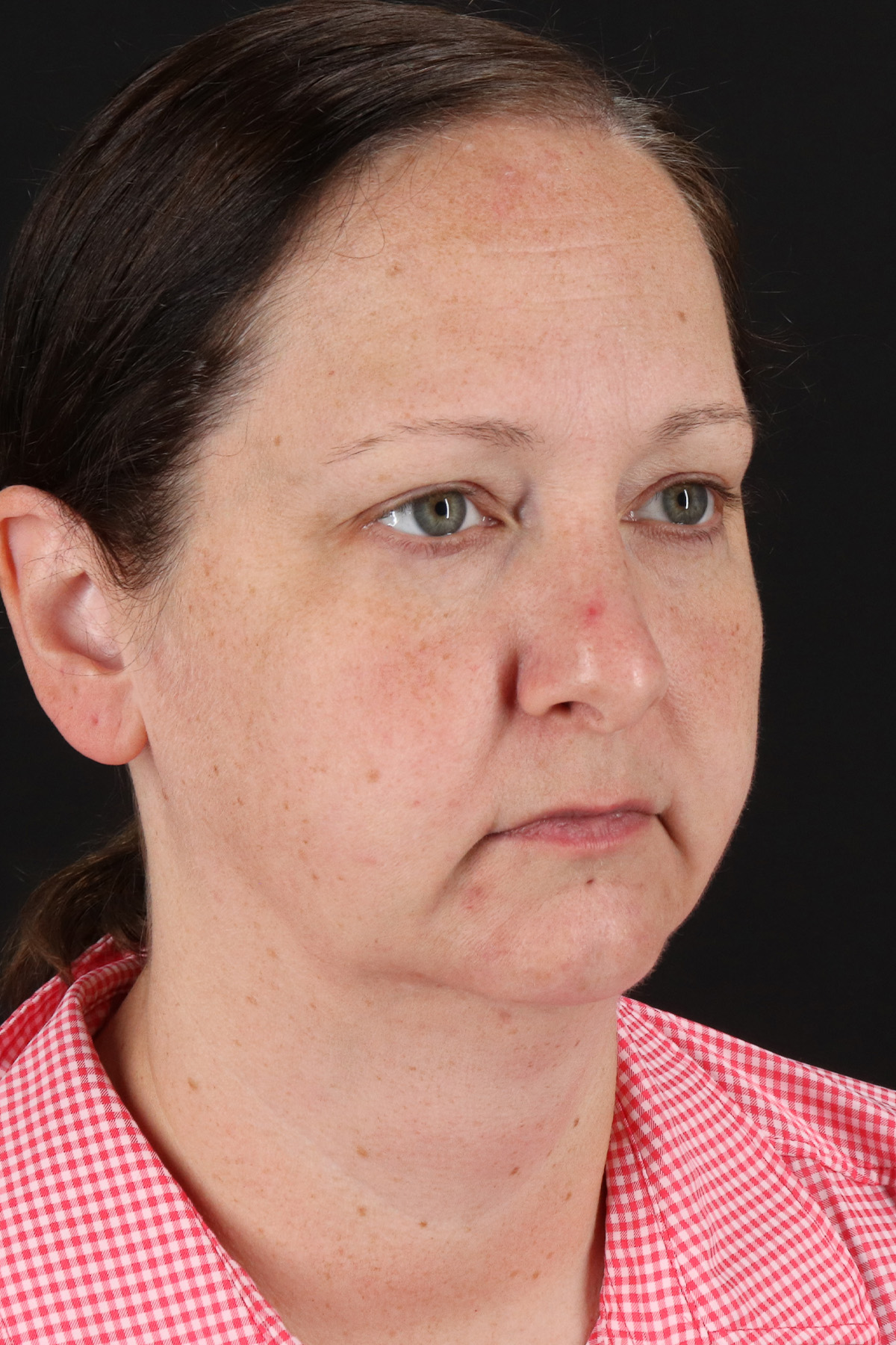 Lower Blepharoplasty Before & After Patient #13052