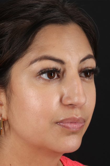 Rhinoplasty Before & After Patient #12458