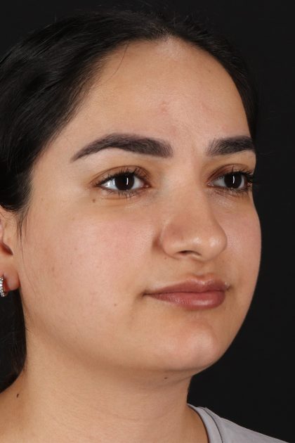 Rhinoplasty Before & After Patient #12436
