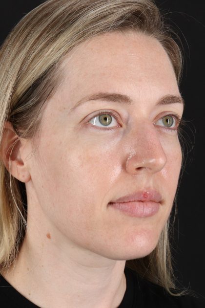 Rhinoplasty Before & After Patient #12227