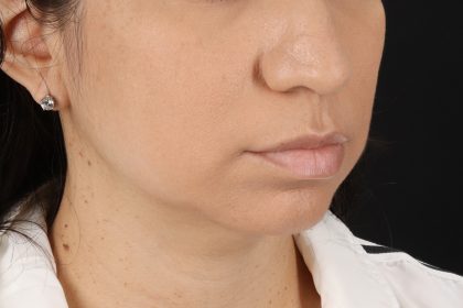 Chin Implant Before & After Patient #13783