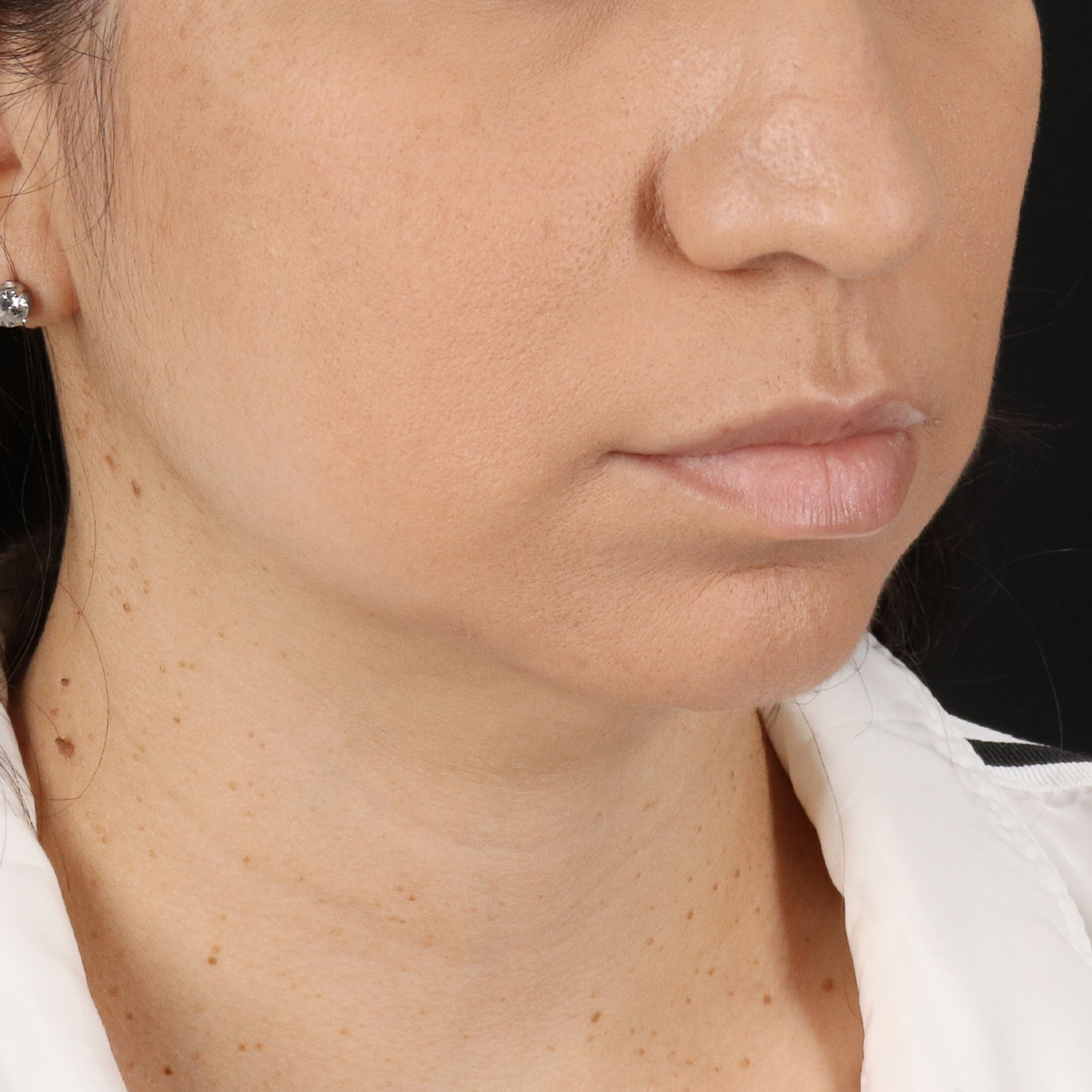 Facelift Before & After Patient #11699