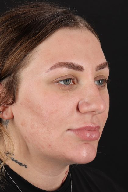 Rhinoplasty Before & After Patient #12403