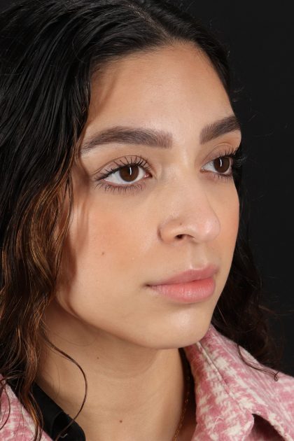 Rhinoplasty Before & After Patient #12249