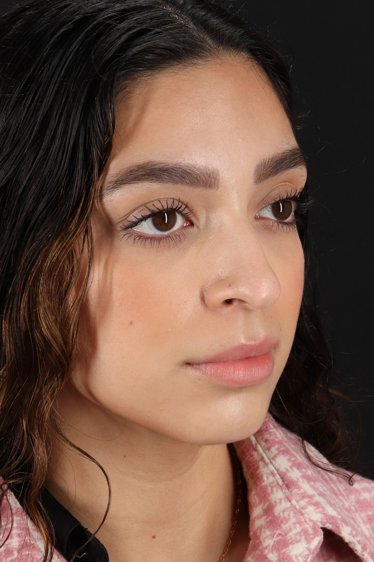 Rhinoplasty Before & After Patient #12249