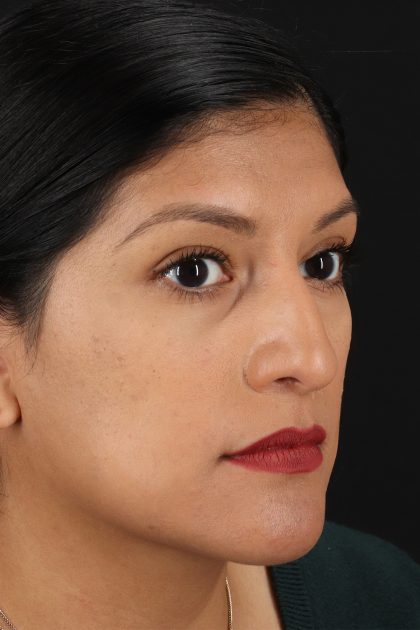 Rhinoplasty Before & After Patient #12337