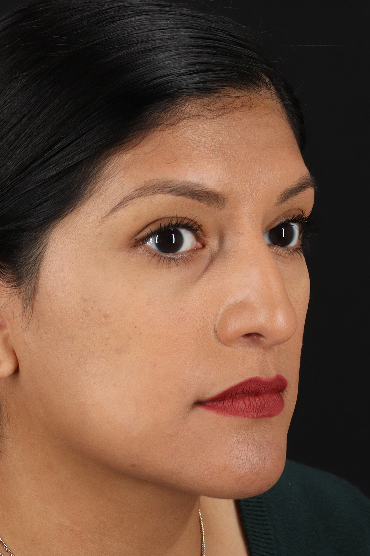 Rhinoplasty Before & After Patient #12337