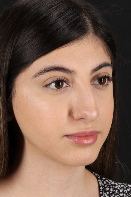 Rhinoplasty Before & After Patient #12304