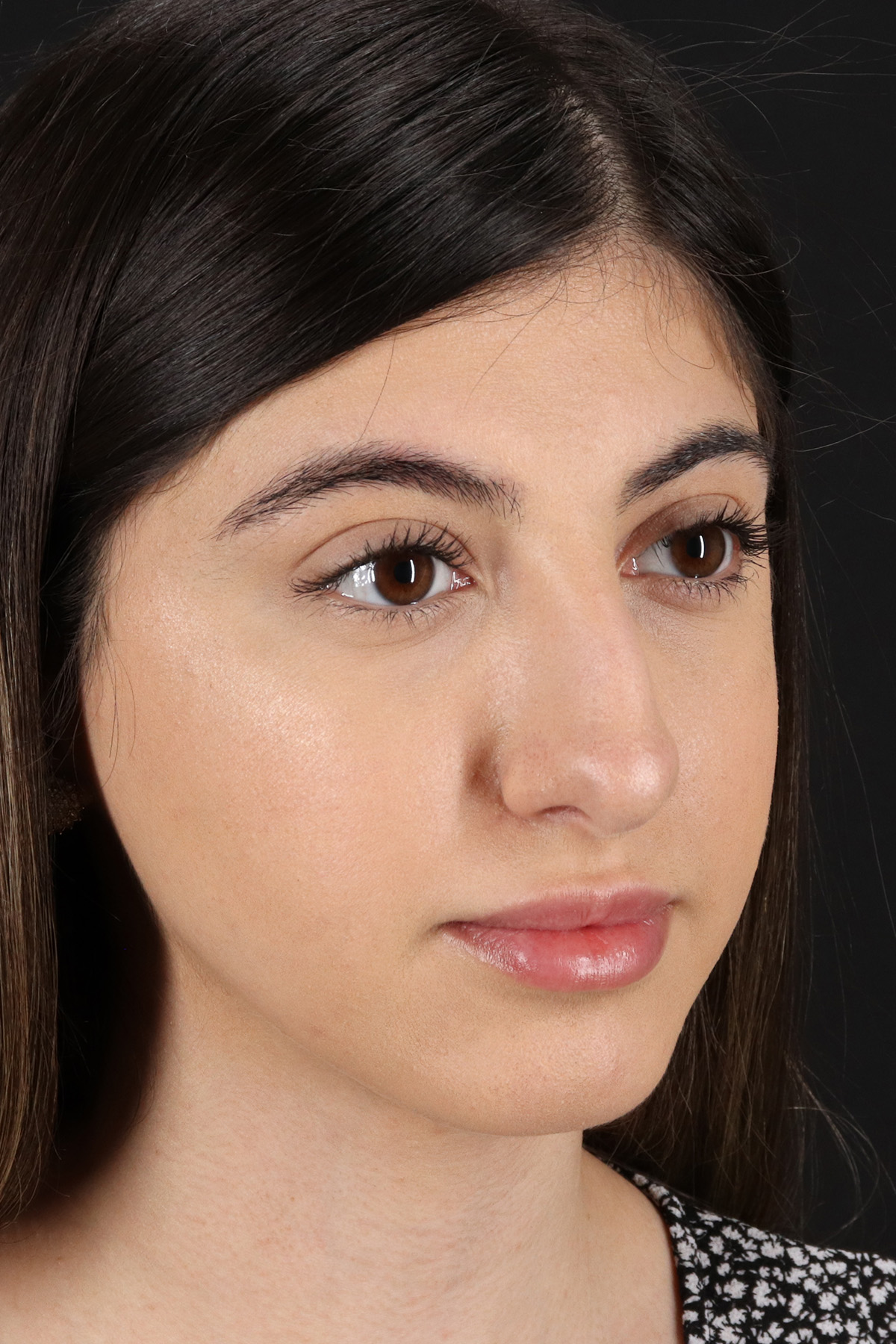 Rhinoplasty Before & After Patient #12304