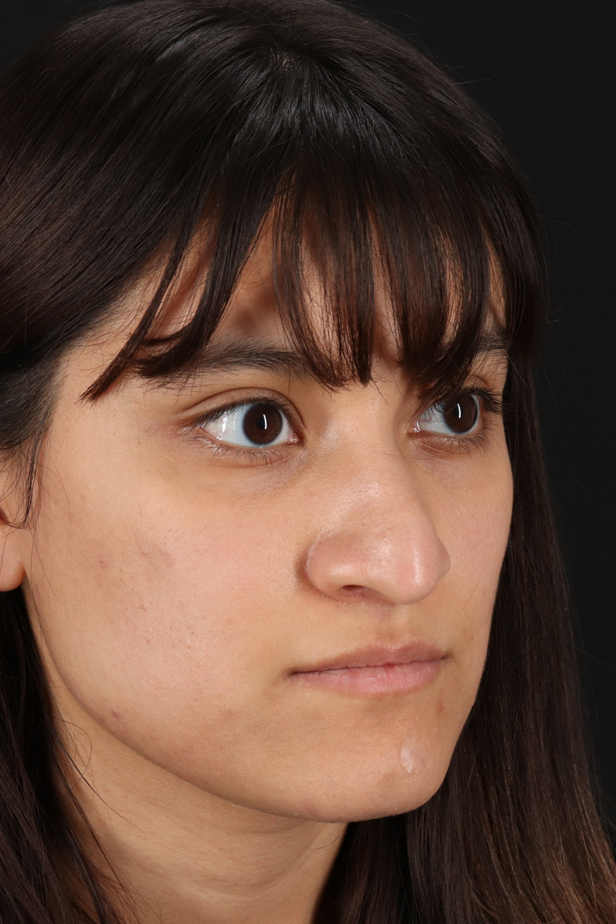 Rhinoplasty Before & After Patient #12469
