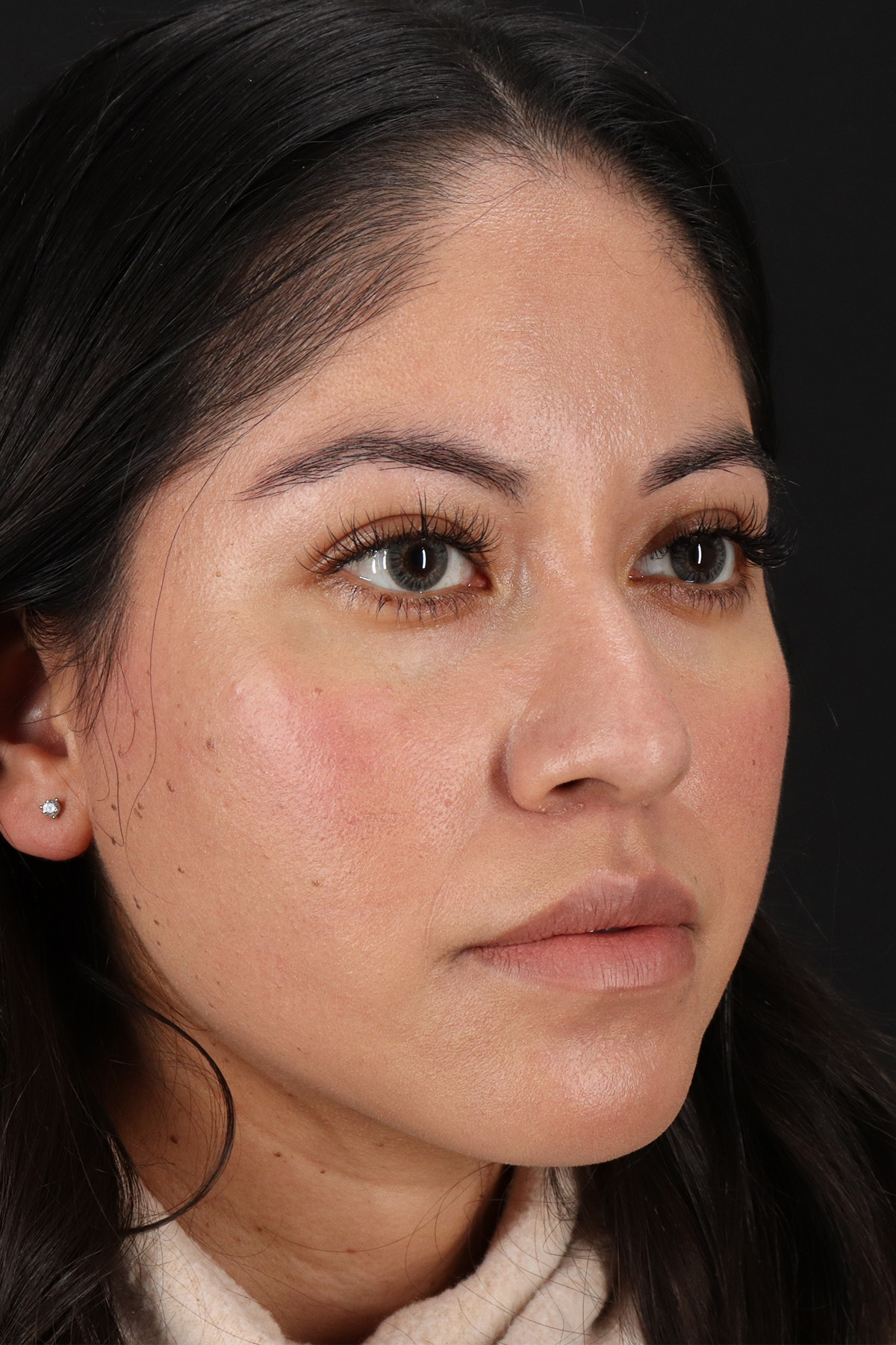 Fillers Before & After Patient #13276