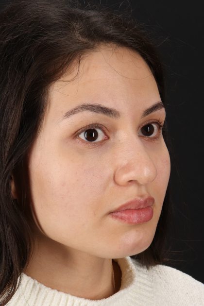 Rhinoplasty Before & After Patient #12282