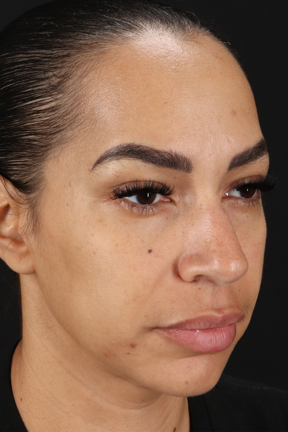 Chin Implant Before & After Patient #11693