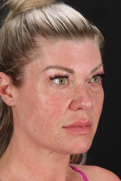 Lower Blepharoplasty Before & After Patient #13030