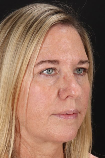 Upper Blepharoplasty Before & After Patient #12029