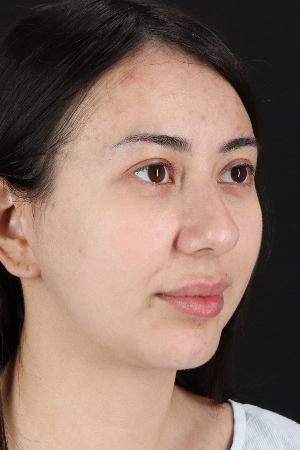 Rhinoplasty Before & After Patient #12359