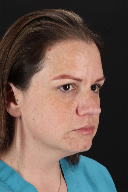 Chemical Peels Before & After Patient #11070