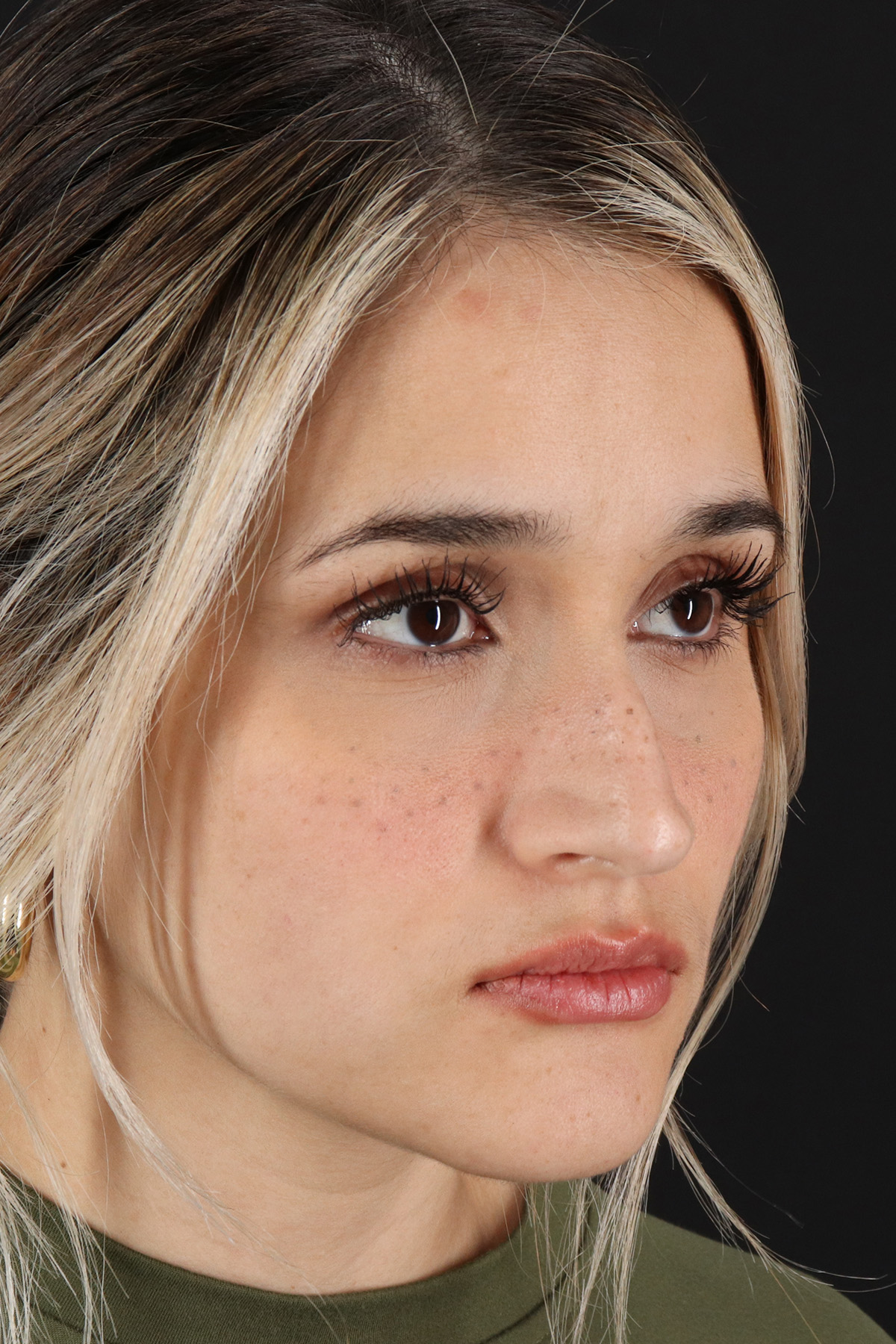 Rhinoplasty Before & After Patient #12260