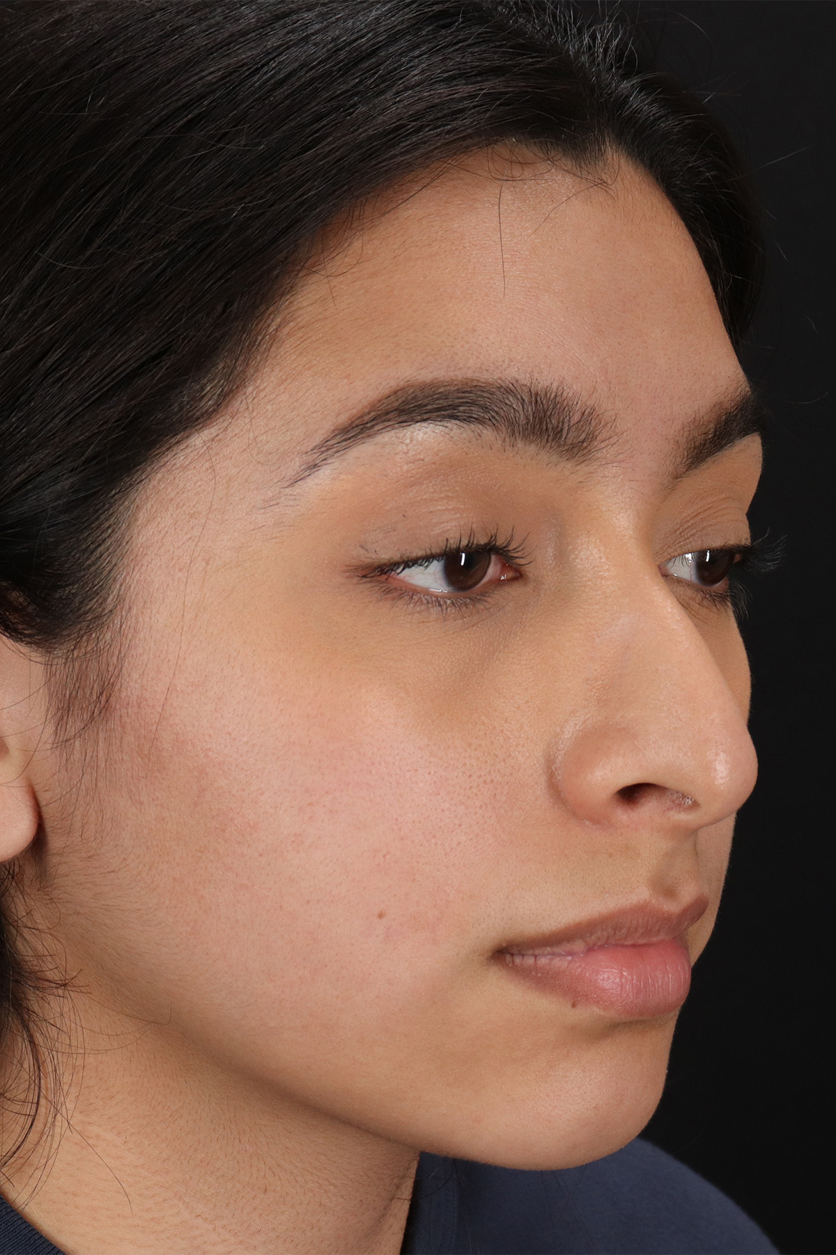 Chin Implant Before & After Patient #13706
