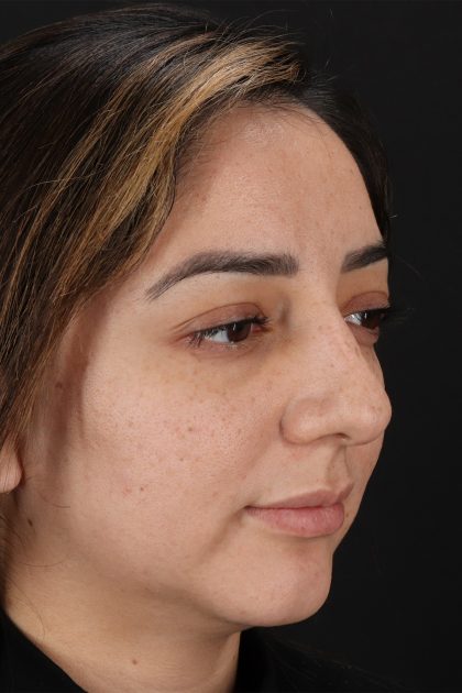 Rhinoplasty Before & After Patient #12392