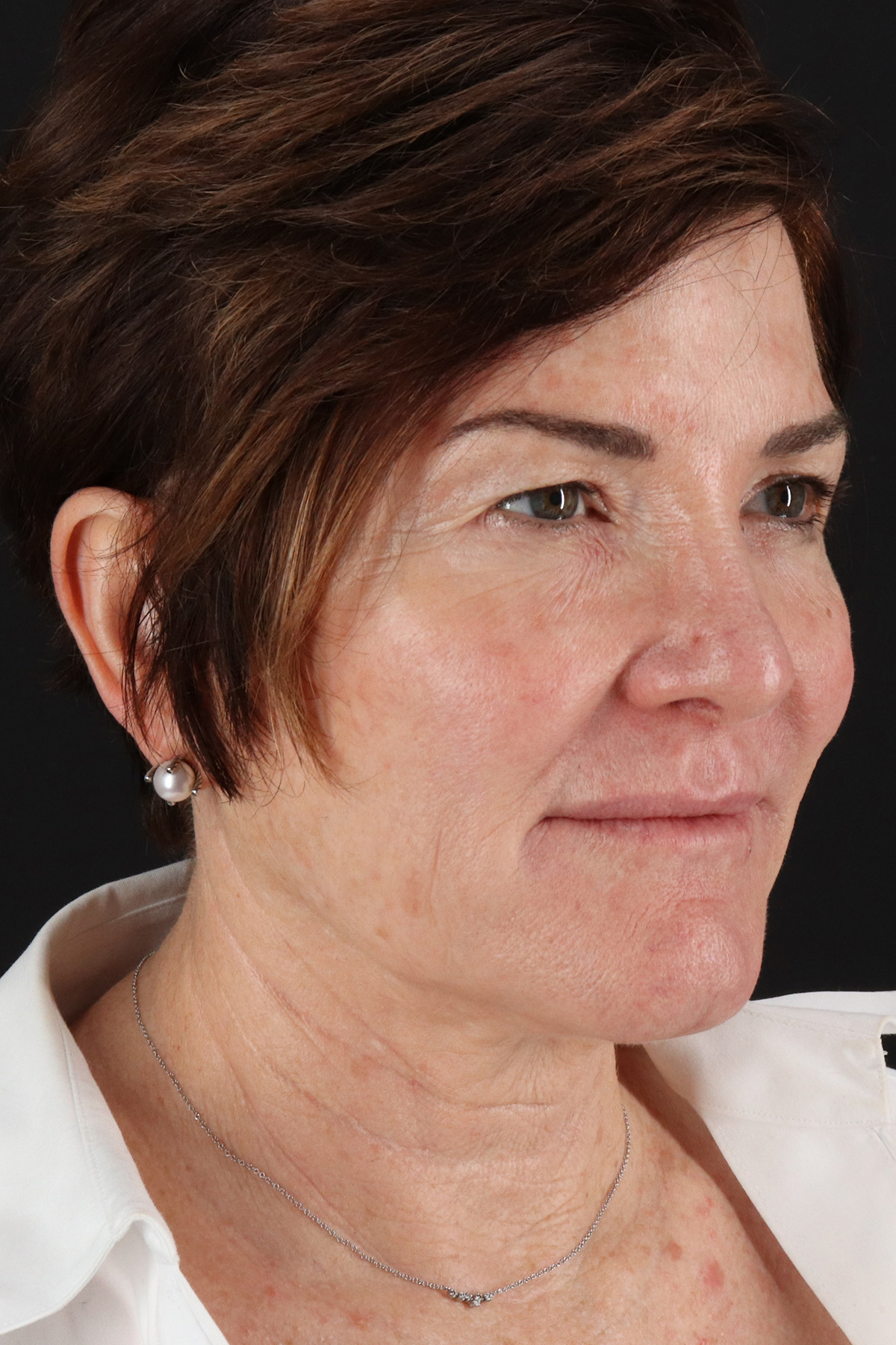 Facelift Before & After Patient #10815