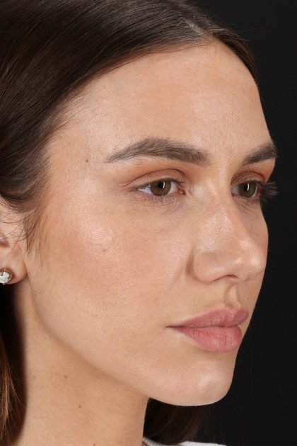 Rhinoplasty Before & After Patient #12370