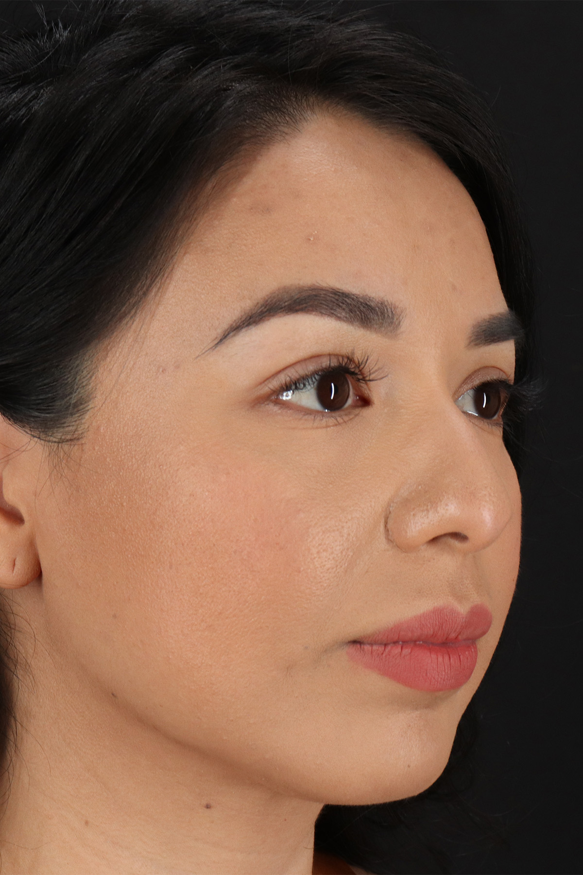 Chin Implant Before & After Patient #13717