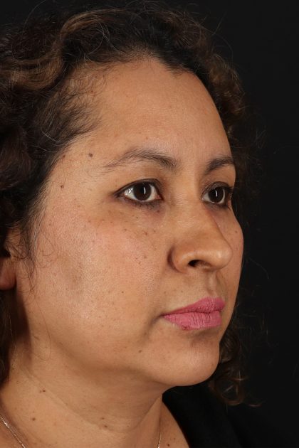Rhinoplasty Before & After Patient #12293