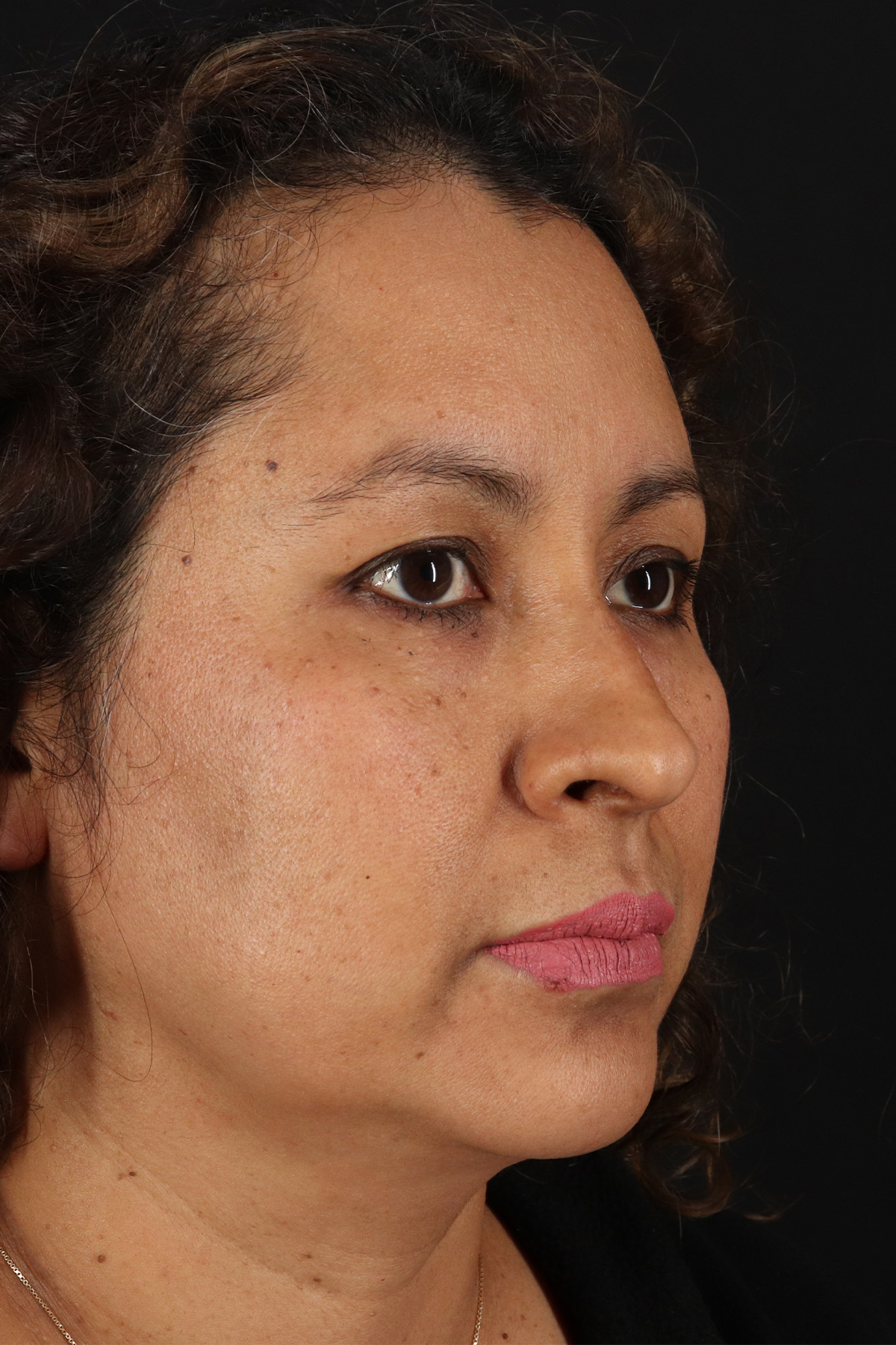 Rhinoplasty Before & After Patient #12293