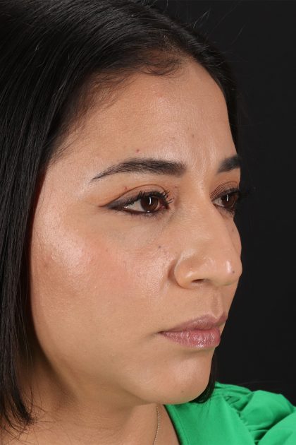 Rhinoplasty Before & After Patient #12425