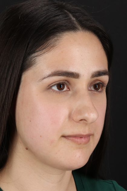 Liquid Rhinoplasty Before & After Patient #11339