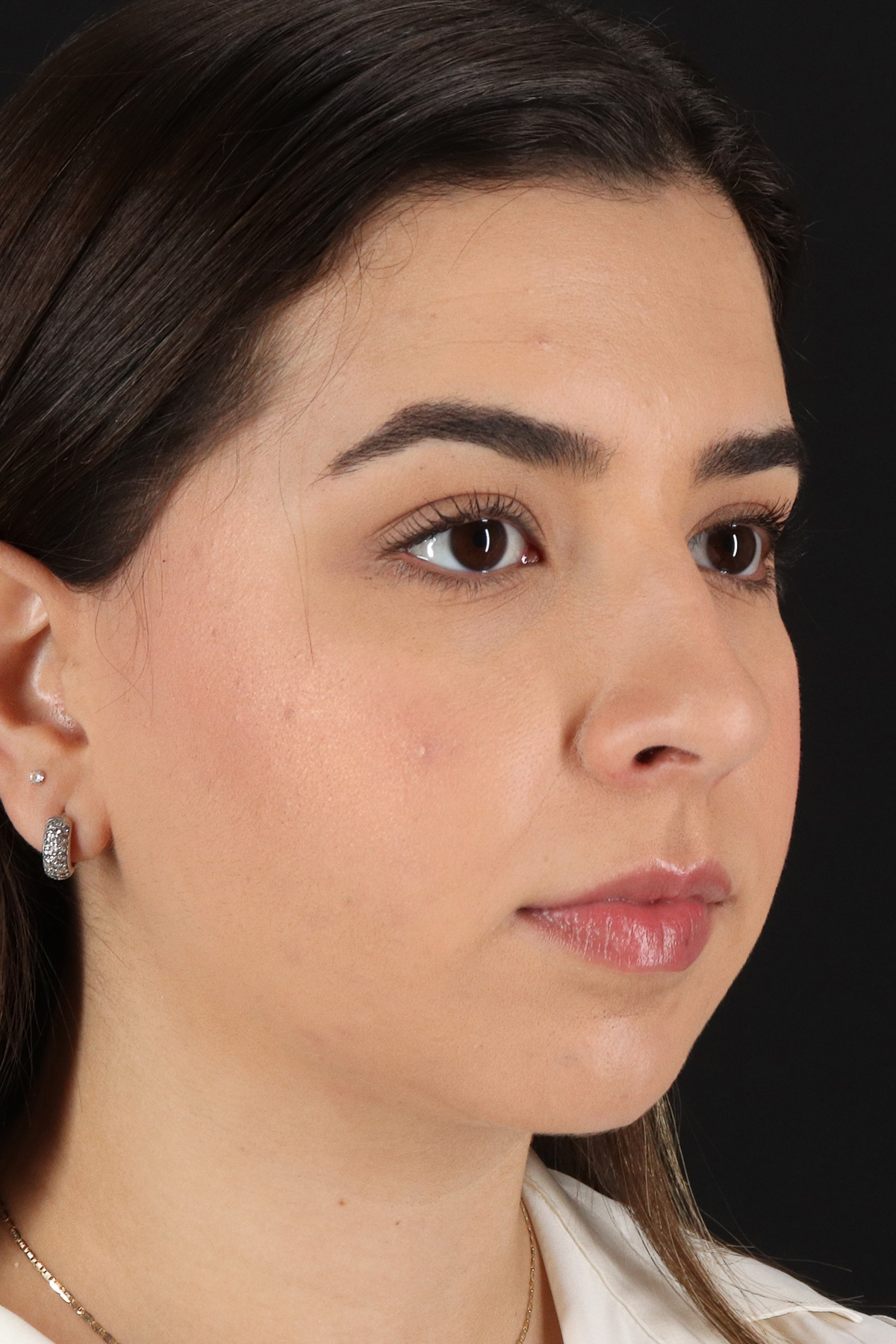 Chin Implant Before & After Patient #11694