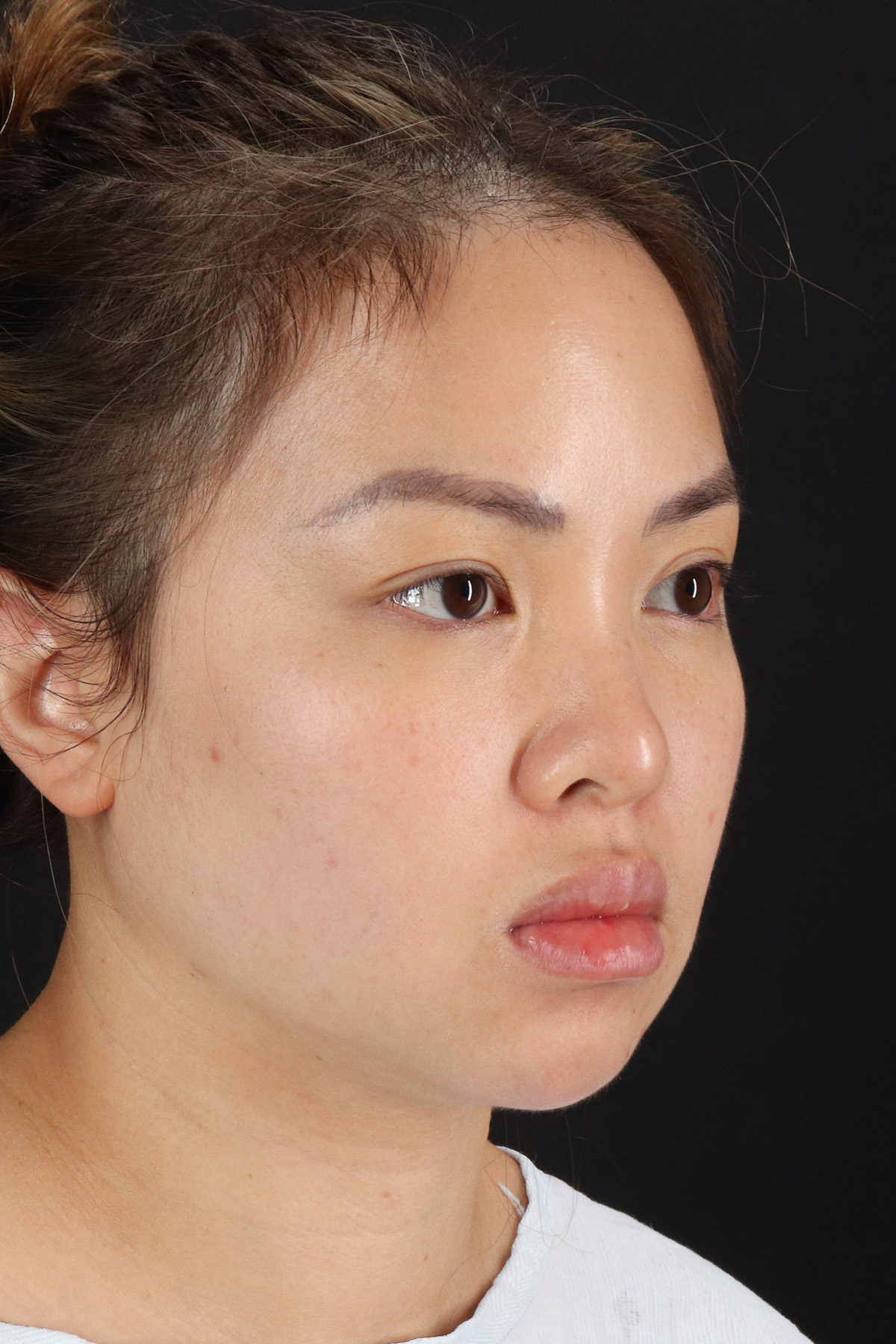 Chin Implant Before & After Patient #13816