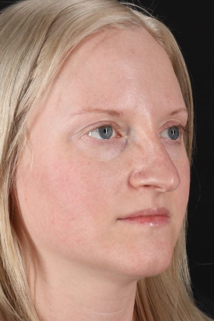 Rhinoplasty Before & After Patient #12381
