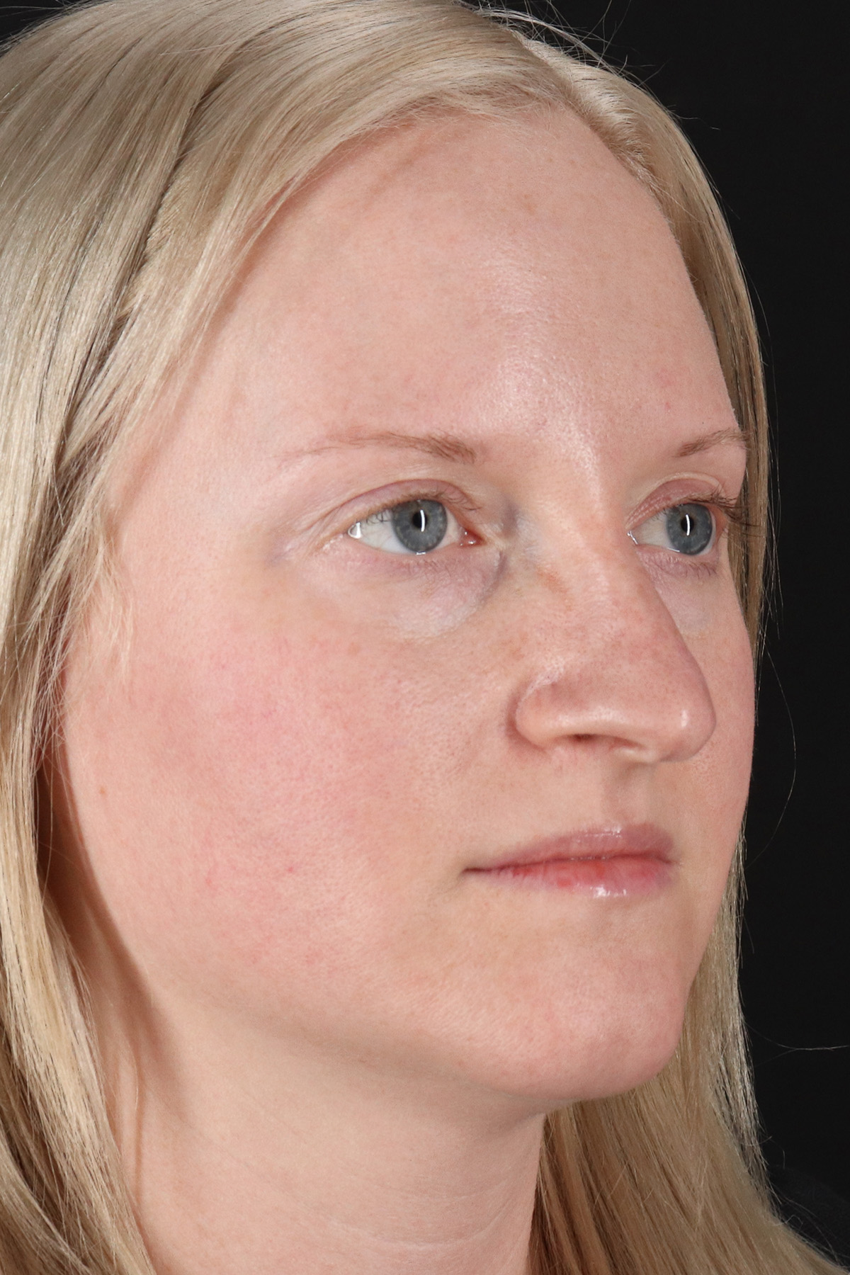 Rhinoplasty Before & After Patient #12381