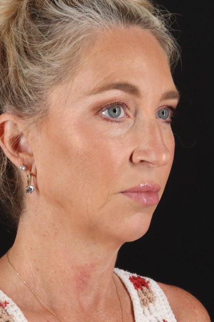 Chin Implant Before & After Patient #13827