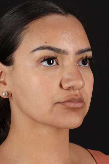Rhinoplasty Before & After Patient #12326