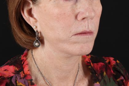 Neck Liposuction Before & After Patient #12117