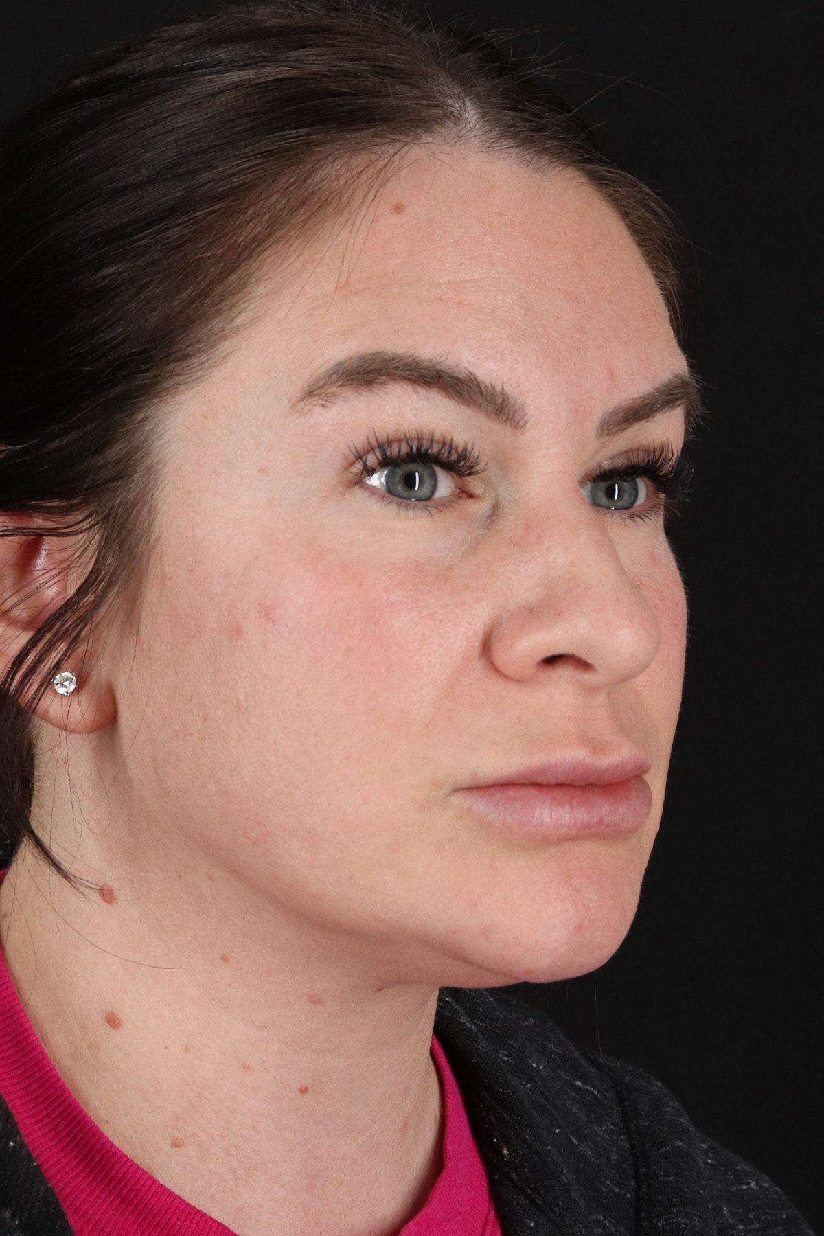 Rhinoplasty Before & After Patient #12414