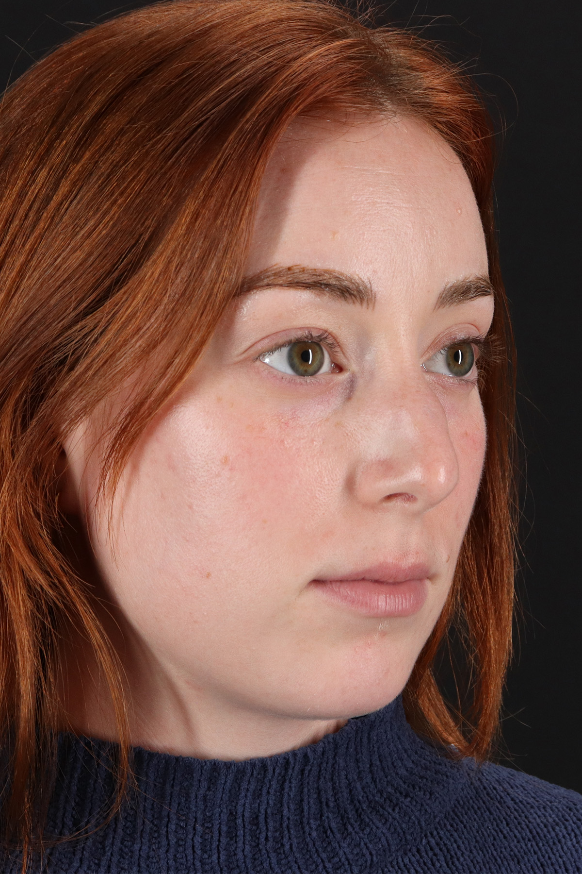 Rhinoplasty Before & After Patient #12348