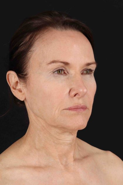 Fat Grafting To The Face Before & After Patient #11839