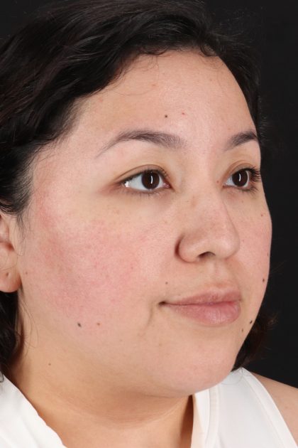 Rhinoplasty Before & After Patient #12447