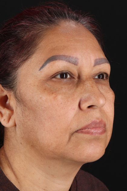 Upper Blepharoplasty Before & After Patient #12051