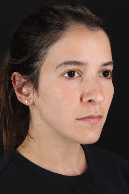 CO2 Laser Before & After Patient #11103