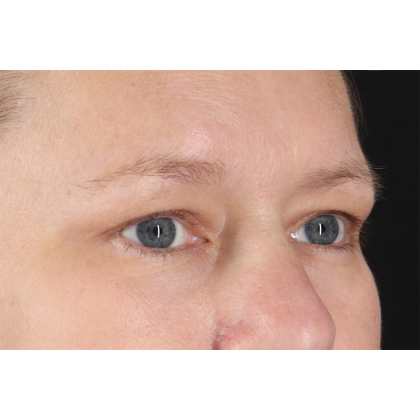 Blepharoplasty (Eyelid Surgery) Before & After Patient #10991