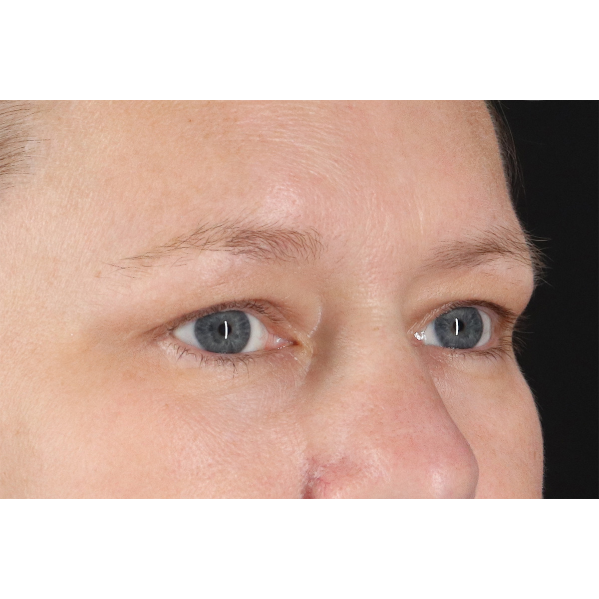 Blepharoplasty (Eyelid Surgery) Before & After Patient #10991