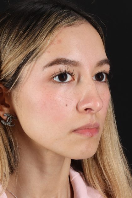Rhinoplasty Before & After Patient #12216