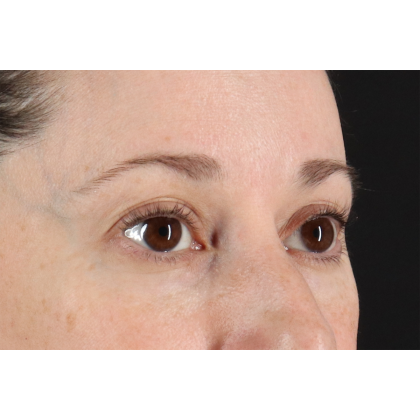 Blepharoplasty (Eyelid Surgery) Before & After Patient #11114