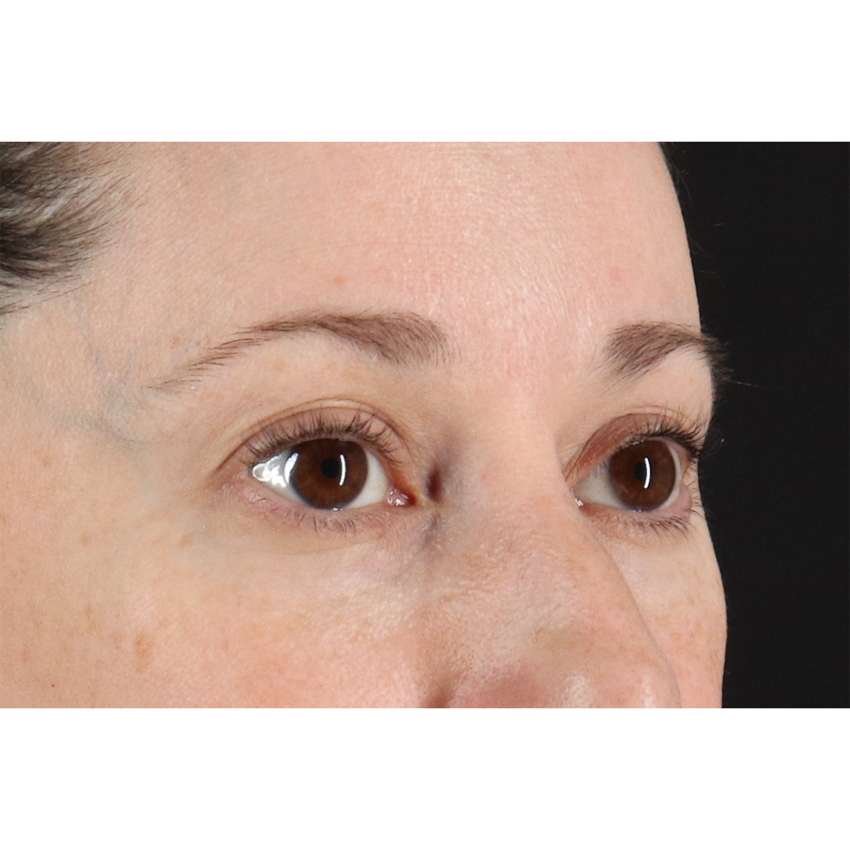 Blepharoplasty (Eyelid Surgery) Before & After Patient #11114