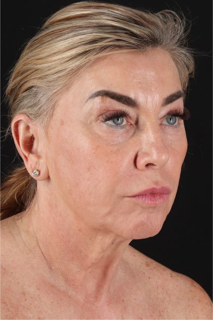 Facelift Before & After Patient #11462